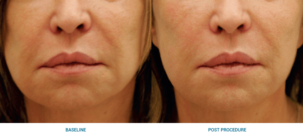 Image of an axilla treatment aimed at skin rejuvenation.