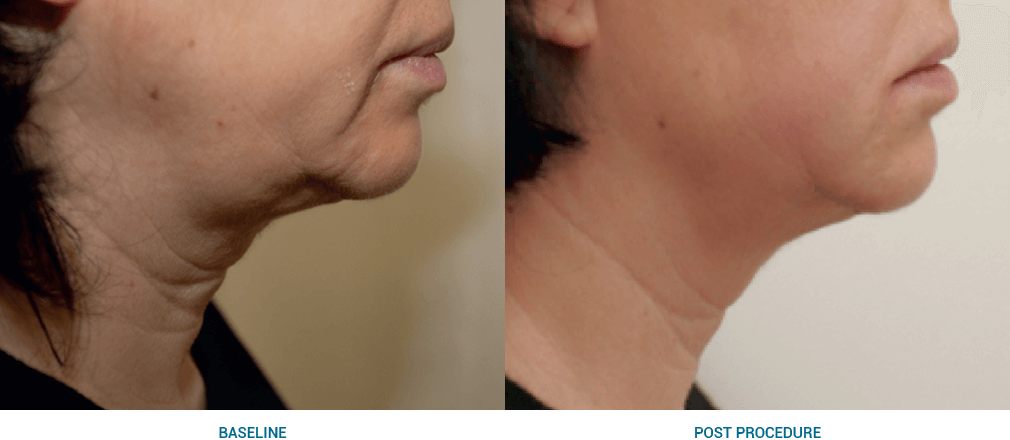 Image depicting double chin treatment solutions.