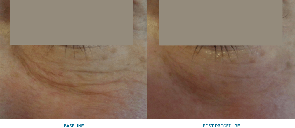 Image depicting fine wrinkle treatment solutions.