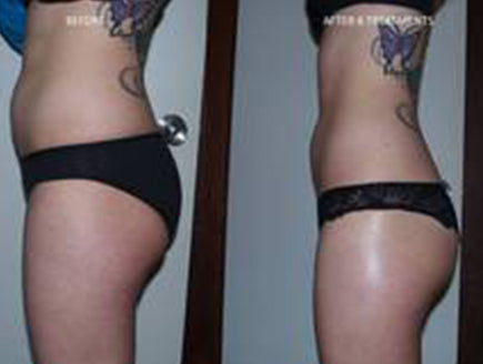 Thumbnail image showcasing a female waist contouring treatment.