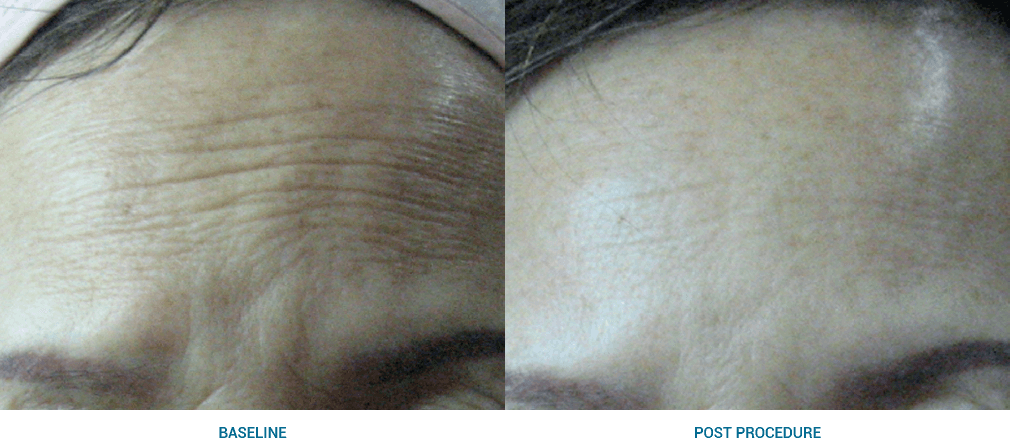 Image depicting forehead wrinkle treatment solutions.